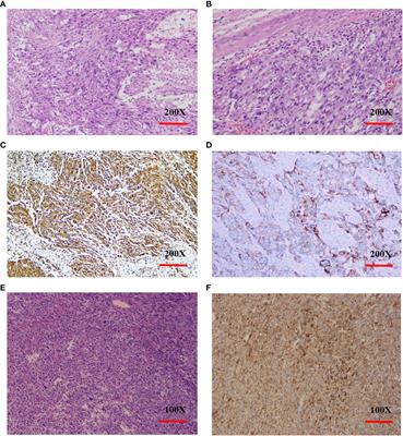 Pembrolizumab combined with anlotinib improves therapeutic efficacy in pulmonary sarcomatoid carcinoma with TMB-H and PD-L1 expression: a case report and literature review